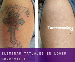 Eliminar tatuajes en Lower Boydsville