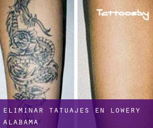 Eliminar tatuajes en Lowery (Alabama)