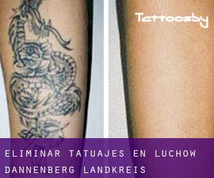 Eliminar tatuajes en Lüchow-Dannenberg Landkreis