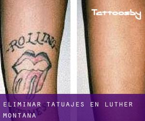 Eliminar tatuajes en Luther (Montana)
