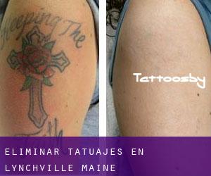 Eliminar tatuajes en Lynchville (Maine)