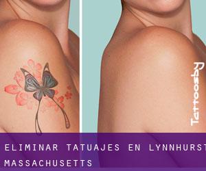 Eliminar tatuajes en Lynnhurst (Massachusetts)