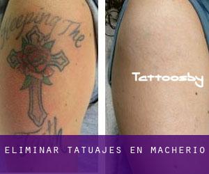 Eliminar tatuajes en Macherio