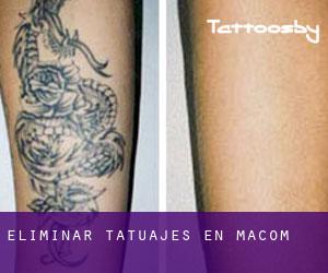 Eliminar tatuajes en Macom