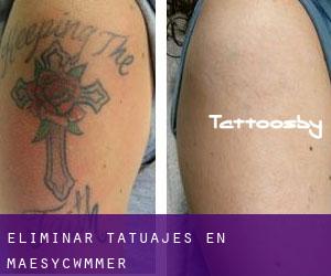 Eliminar tatuajes en Maesycwmmer