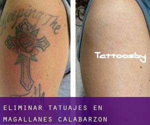 Eliminar tatuajes en Magallanes (Calabarzon)