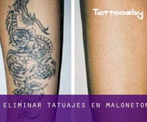 Eliminar tatuajes en Maloneton