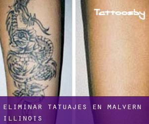 Eliminar tatuajes en Malvern (Illinois)