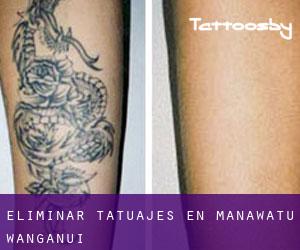 Eliminar tatuajes en Manawatu-Wanganui