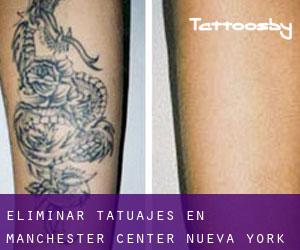 Eliminar tatuajes en Manchester Center (Nueva York)