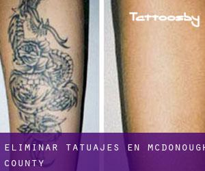 Eliminar tatuajes en McDonough County