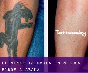 Eliminar tatuajes en Meadow Ridge (Alabama)