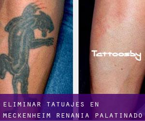 Eliminar tatuajes en Meckenheim (Renania-Palatinado)