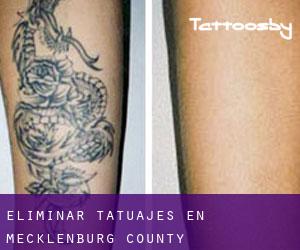 Eliminar tatuajes en Mecklenburg County