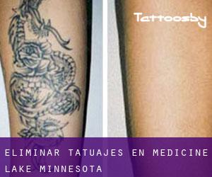 Eliminar tatuajes en Medicine Lake (Minnesota)