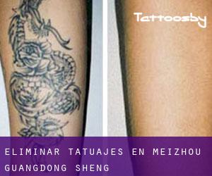 Eliminar tatuajes en Meizhou (Guangdong Sheng)