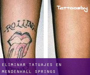 Eliminar tatuajes en Mendenhall Springs