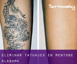 Eliminar tatuajes en Mentone (Alabama)