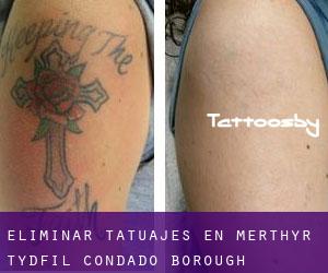 Eliminar tatuajes en Merthyr Tydfil (Condado Borough)
