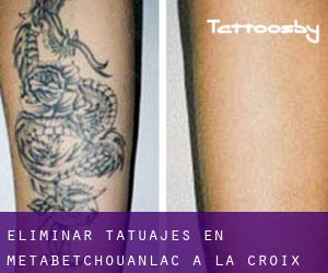 Eliminar tatuajes en Metabetchouan–Lac-a-la-Croix