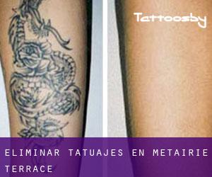 Eliminar tatuajes en Metairie Terrace