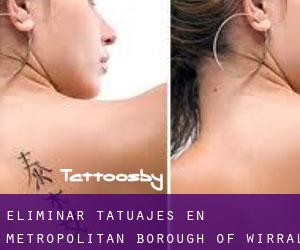 Eliminar tatuajes en Metropolitan Borough of Wirral