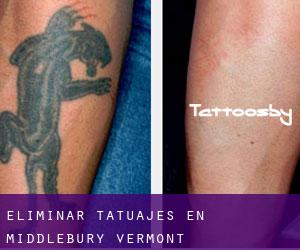 Eliminar tatuajes en Middlebury (Vermont)