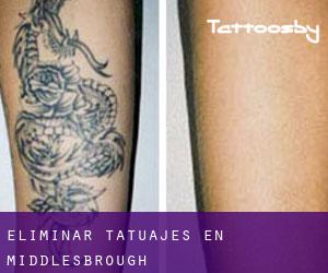 Eliminar tatuajes en Middlesbrough