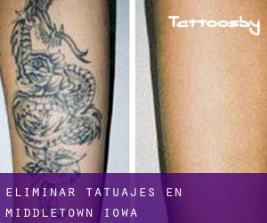 Eliminar tatuajes en Middletown (Iowa)