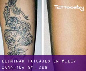 Eliminar tatuajes en Miley (Carolina del Sur)