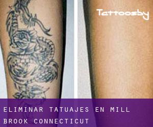 Eliminar tatuajes en Mill Brook (Connecticut)