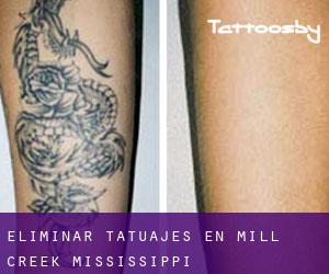 Eliminar tatuajes en Mill Creek (Mississippi)