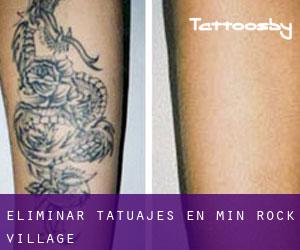 Eliminar tatuajes en Min - Rock Village