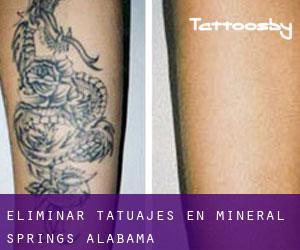 Eliminar tatuajes en Mineral Springs (Alabama)