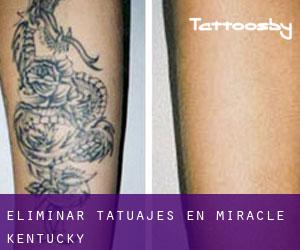 Eliminar tatuajes en Miracle (Kentucky)