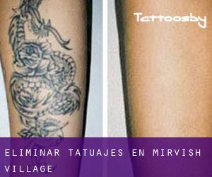 Eliminar tatuajes en Mirvish Village