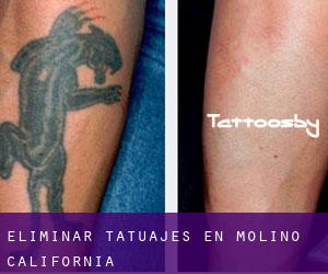 Eliminar tatuajes en Molino (California)