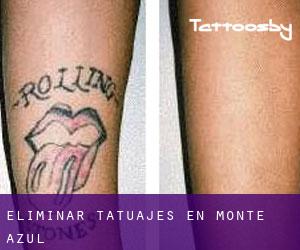 Eliminar tatuajes en Monte Azul