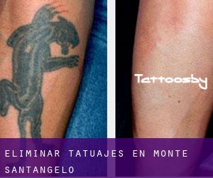 Eliminar tatuajes en Monte Sant'Angelo
