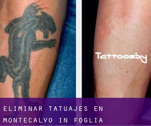 Eliminar tatuajes en Montecalvo in Foglia