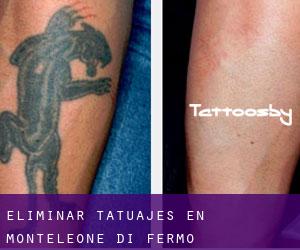 Eliminar tatuajes en Monteleone di Fermo