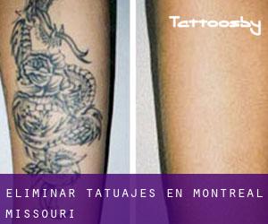 Eliminar tatuajes en Montreal (Missouri)