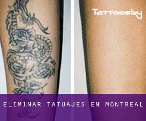 Eliminar tatuajes en Montréal