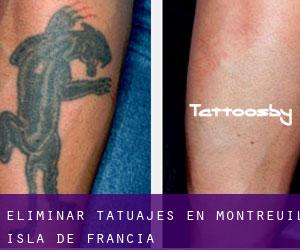 Eliminar tatuajes en Montreuil (Isla de Francia)
