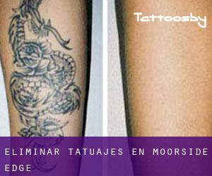 Eliminar tatuajes en Moorside Edge