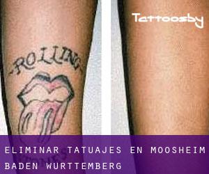 Eliminar tatuajes en Moosheim (Baden-Württemberg)