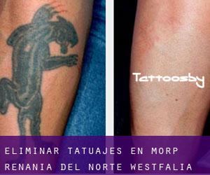 Eliminar tatuajes en Morp (Renania del Norte-Westfalia)