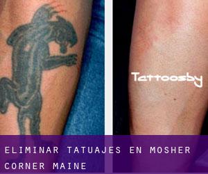 Eliminar tatuajes en Mosher Corner (Maine)