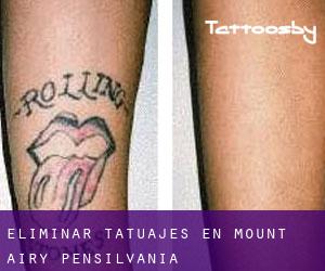 Eliminar tatuajes en Mount Airy (Pensilvania)