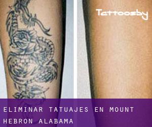 Eliminar tatuajes en Mount Hebron (Alabama)